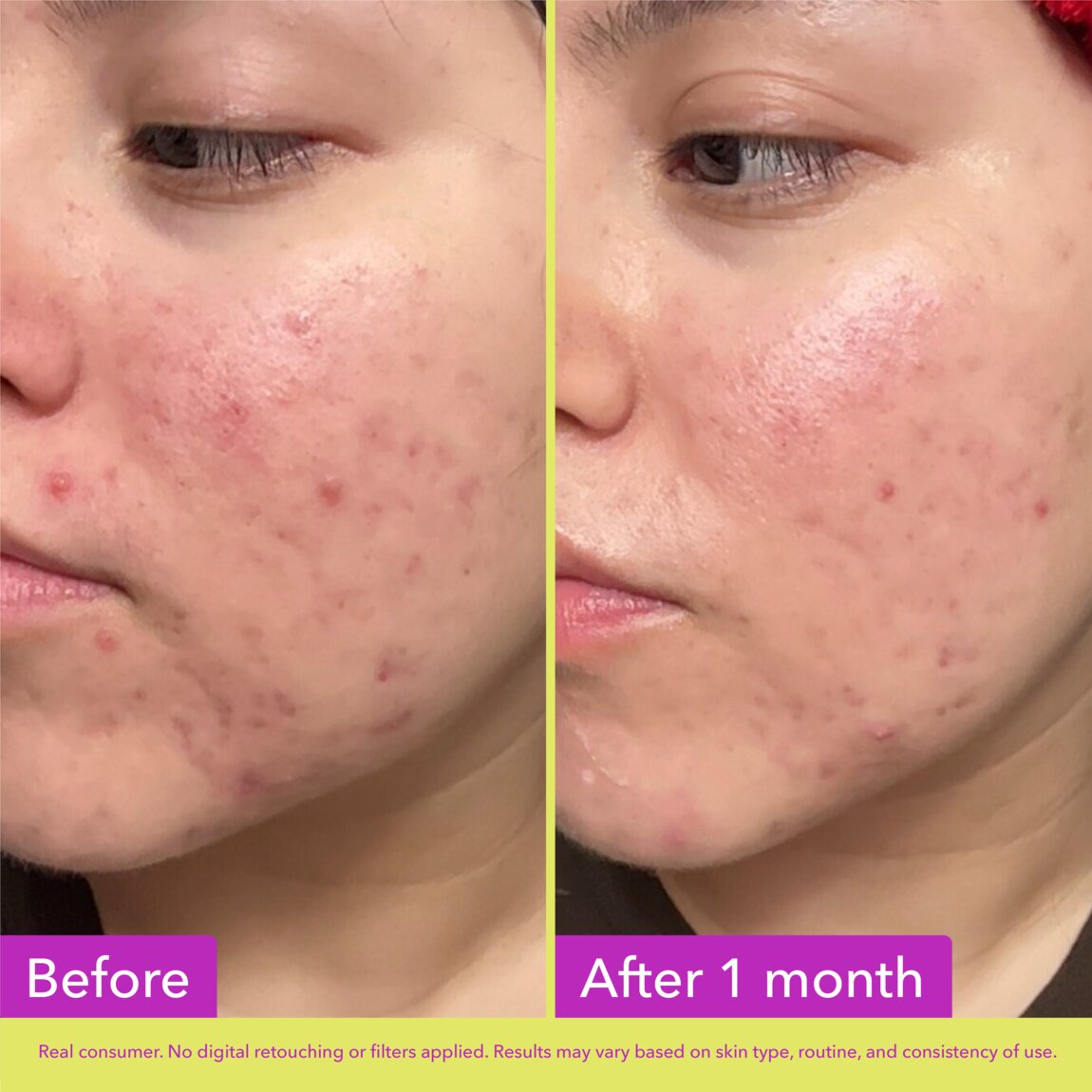 10% Azelaic Acid Treatment U0