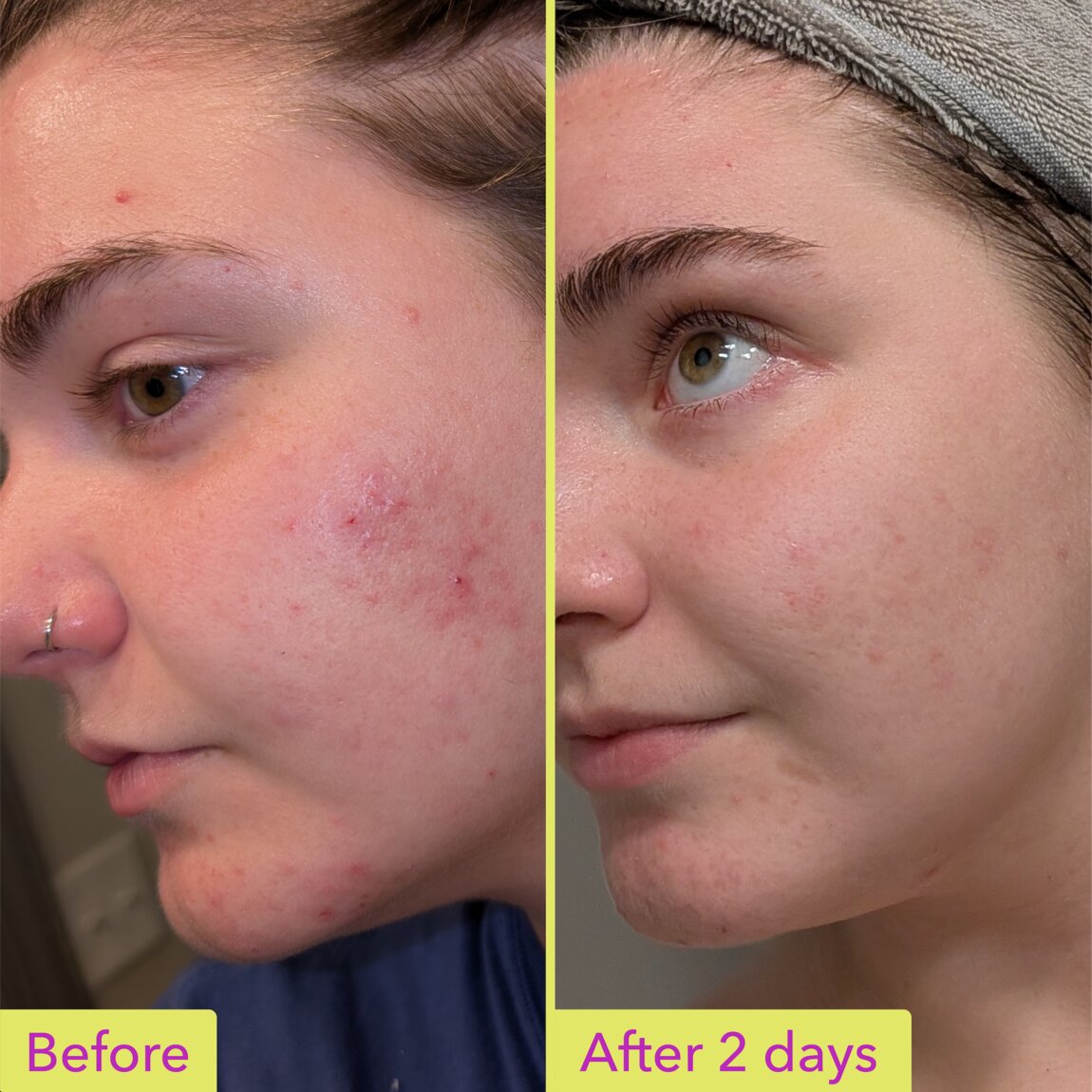 10% Azelaic Acid Treatment T0