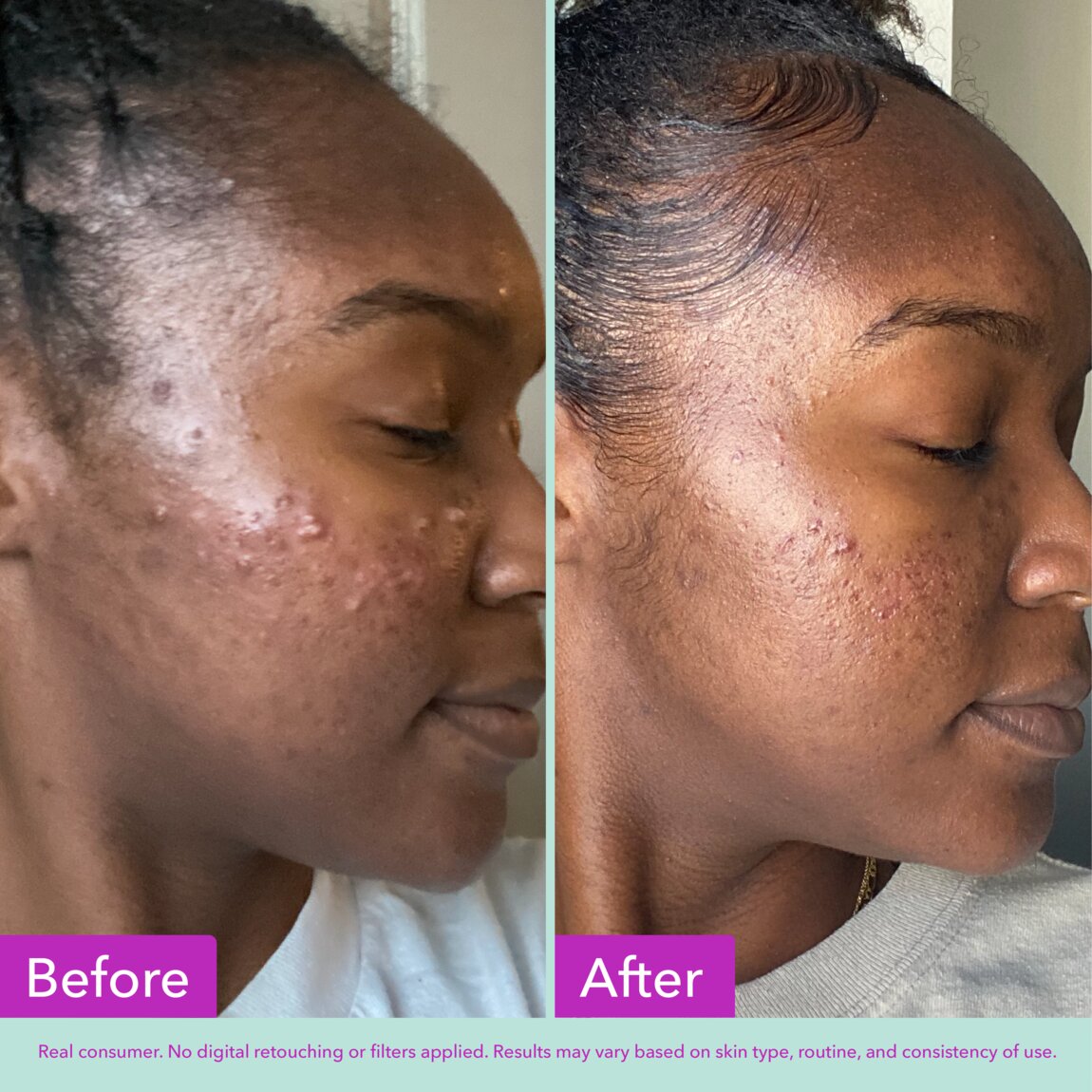Acne Foaming Cleanser L8