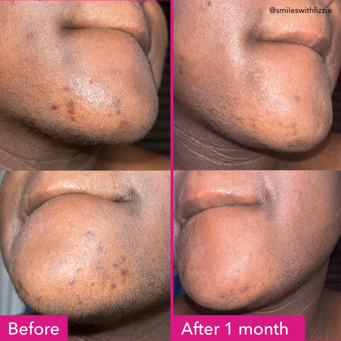 Brightening & Dark Spots Bar X1