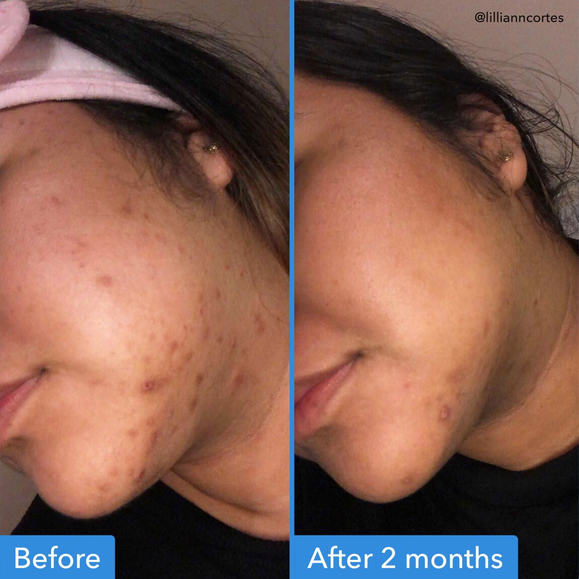 Discoloration Correcting Serum B5