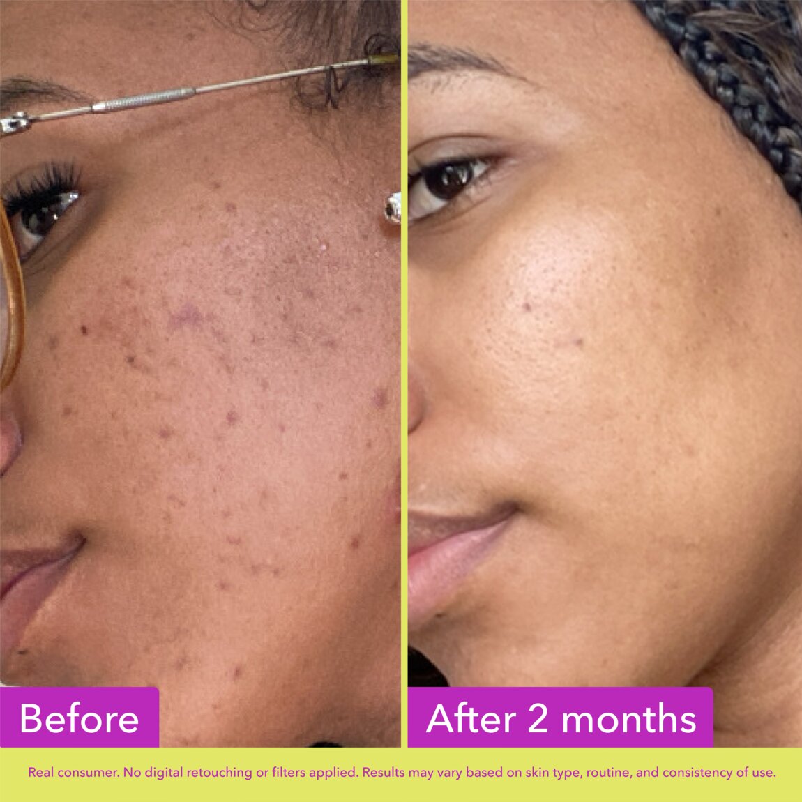 10% Azelaic Acid Treatment U0