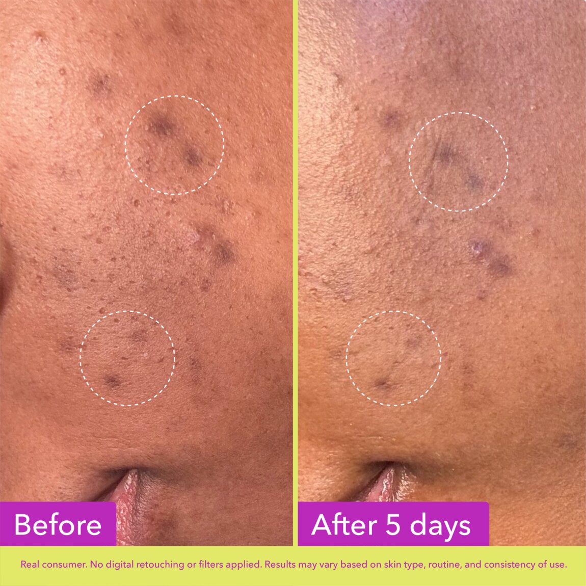 Dark Spot Microdart Patches O5